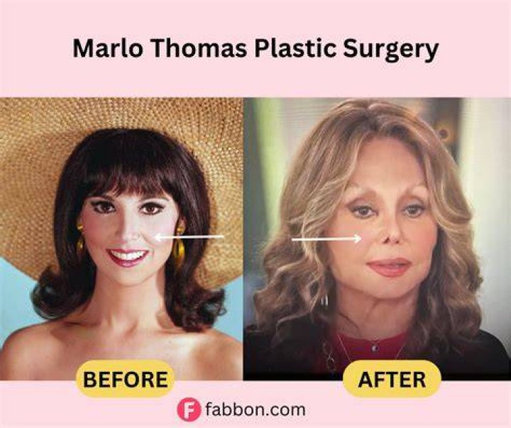 Marlo Thomas Plastic Surgery Nose Job Before and After Facelift, Botox
