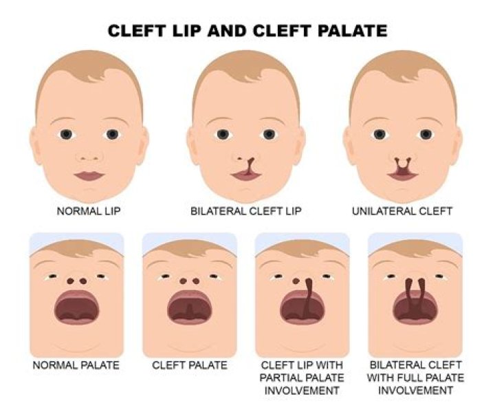 Unbelievable: Celebrities With Cleft Lip And Palate