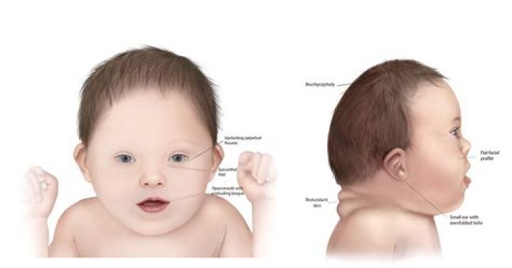 Understanding George Clooney's Life: The Twins And Down Syndrome Journey